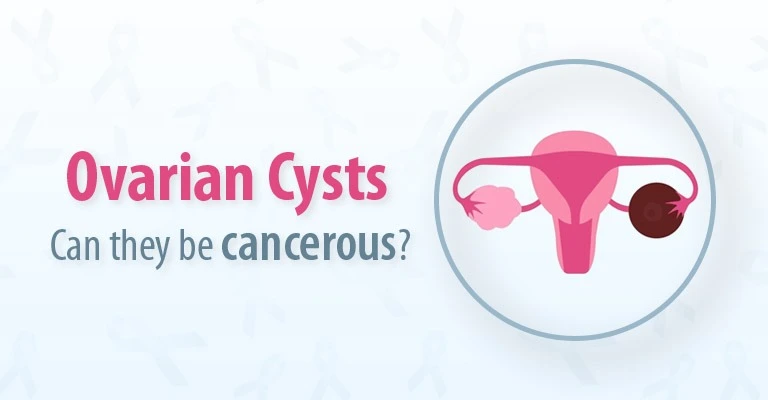 Ovarian Cysts: Can they be cancerous?